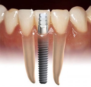 dental implants Warrenton