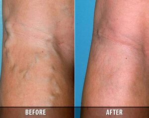 Speaking With A Vein Doctor In Schaumburg IL When Dealing With Varicose Veins