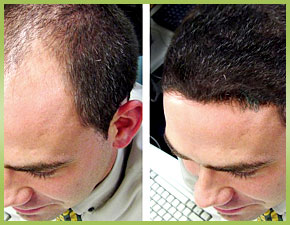 All You Need to Know About Mens Hair Transplant in Fort Lauderdale, FL