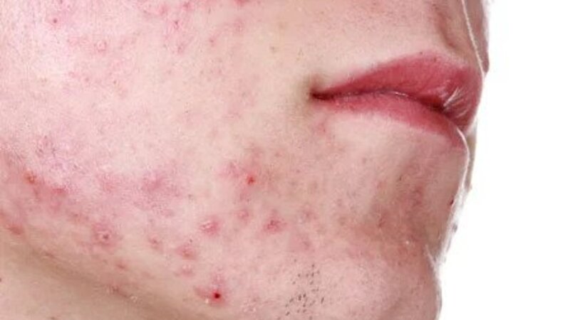 How an Acne Dermatologist Near Maple Grove, MN, Can Help Clear Your Skin