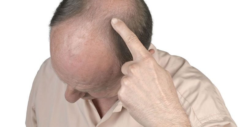 Important Things to Know Before Getting a Hair Transplant in Philadelphia