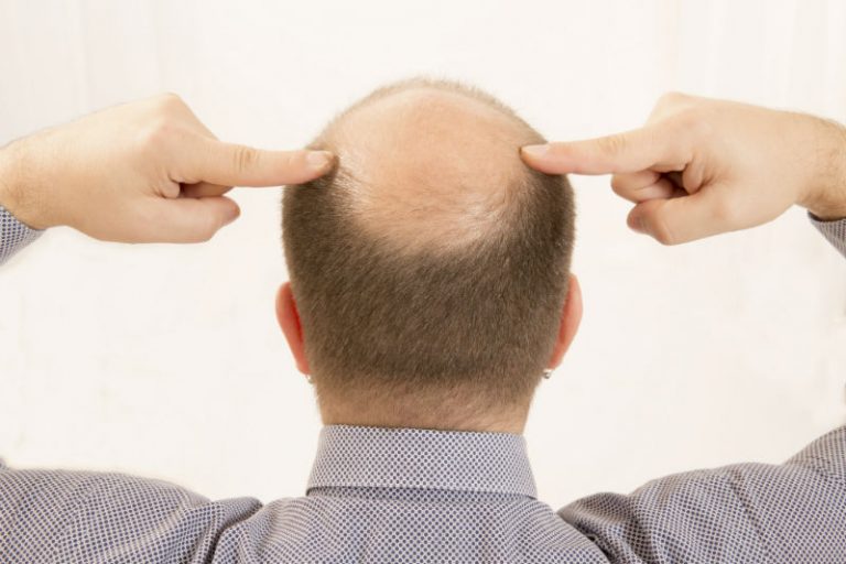 Top Reasons an FUE Hair Transplant in Fort Lauderdale, FL Is the Best to Get