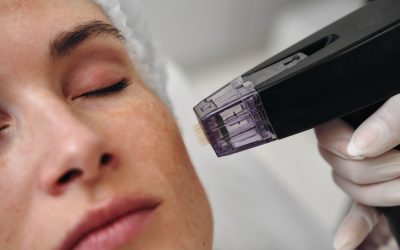 Revitalize Your Look with Microneedling in Westminster, CO