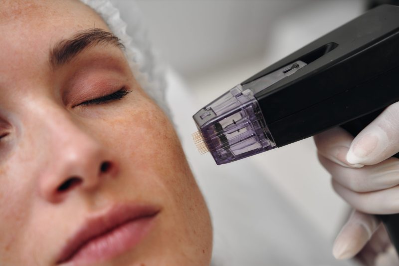 Revitalize Your Look with Microneedling in Westminster, CO